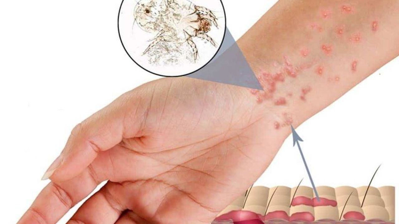 Eczanede Satılan En Etkili Uyuz İlacı Hangisidir?