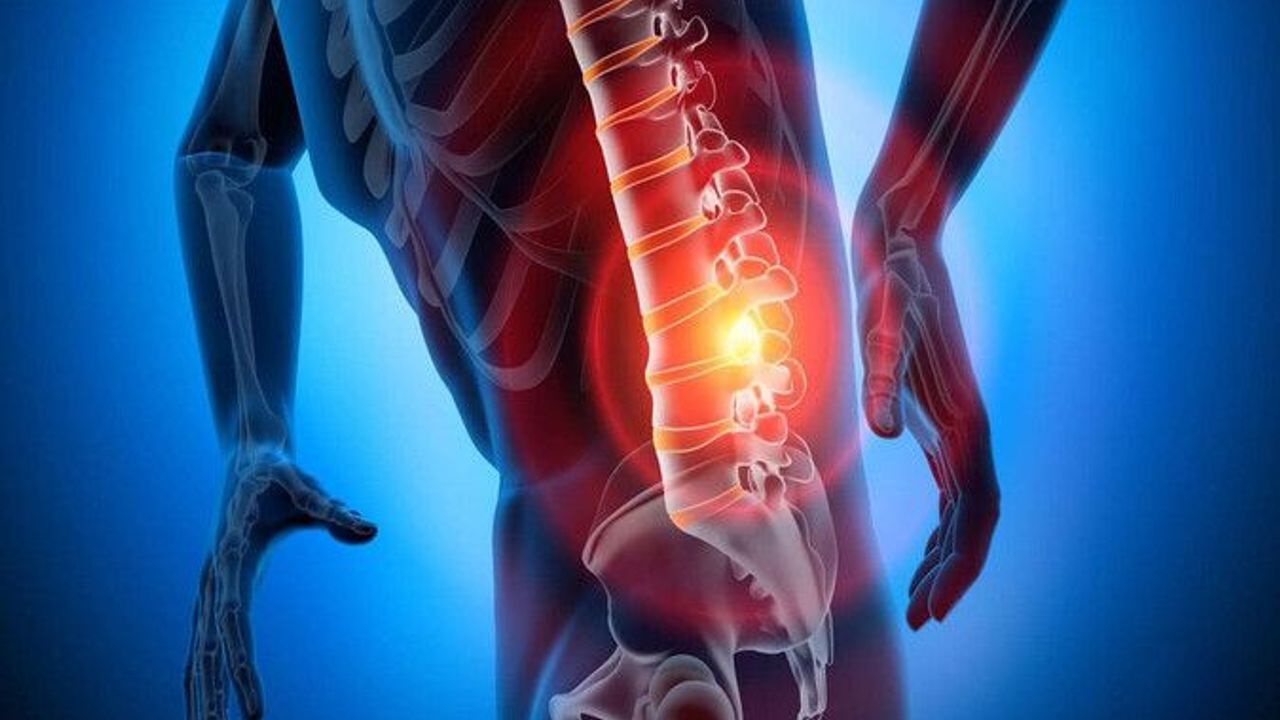 Evde Bel Fıtığı Ağrısına Ne İyi Gelir?