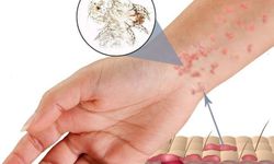 Eczanede Satılan En Etkili Uyuz İlacı Hangisidir?