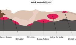 Yatak Yarası Nedir? Nasıl Tedavi Edilir? Krem Tavsiyeleri ve Resimler      