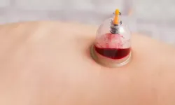 Her derde deva: Hacamat tedavisi hakkında her şey! Hacamat nedir? Faydaları nelerdir?