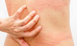 Gizemli Bir Kimyasal: Histamin ve Bedenimizdeki Rolü