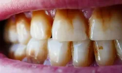 Dişlerdeki Kahverengi Lekeleri Anında Yok Eden Yöntem: Dişçiye Gitmeye Son!