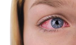 Göz alerjisi olduğunuzu nasıl anlarsınız?