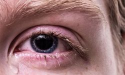Gözlerde Batma ve Sulanma Ciddi Hastalık Habercisi