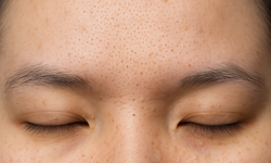 Komedon Nasıl Geçer?