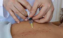 Nöral Terapi ile Ağrısız Hayat