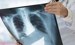 Zatürre Basit Bir Hastalık Değil