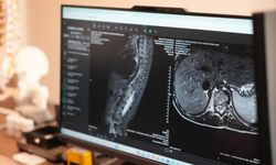 Skolyoz Erken Tanıyla Kontrol Altına Alınabilir