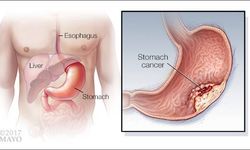 İnce Bağırsaktan Yeni Mide Oluşturuldu