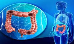 Kolon Kanserinde Erken Tanı Hayat Kurtarıyor