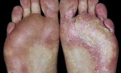 Ayak Mantarından Korunmak İçin 10 Etkili Önlem