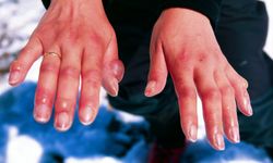 Soğuk ısırığına dikkat: Uzmanlardan önemli uyarılar