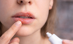 Uçuk Neden Çıkar? Evde Uçuk Nasıl Geçer?