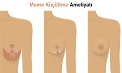 Meme küçültme estetikten fazlasını sağlıyor
