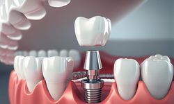 Çene kemiği erimesi olanlar implant yaptırabilir mi?