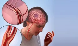 Yüzde kayma ve konuşma bozukluğu inme belirtisi olabilir