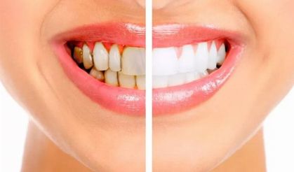 Diş Taşı Temizliğinin Zararı Var Mı? Uzmanı Hayati Açıklamalarda Bulundu!