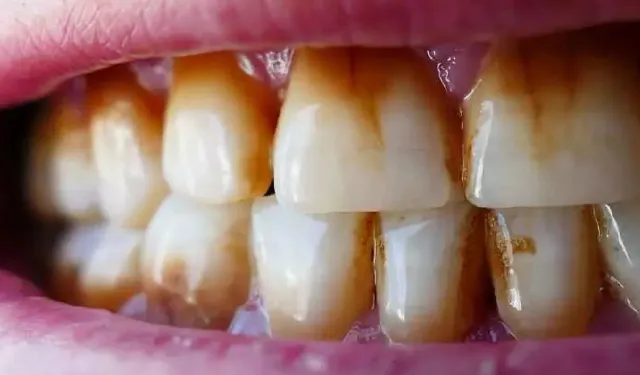 Dişlerdeki Kahverengi Lekeleri Anında Yok Eden Yöntem: Dişçiye Gitmeye Son!