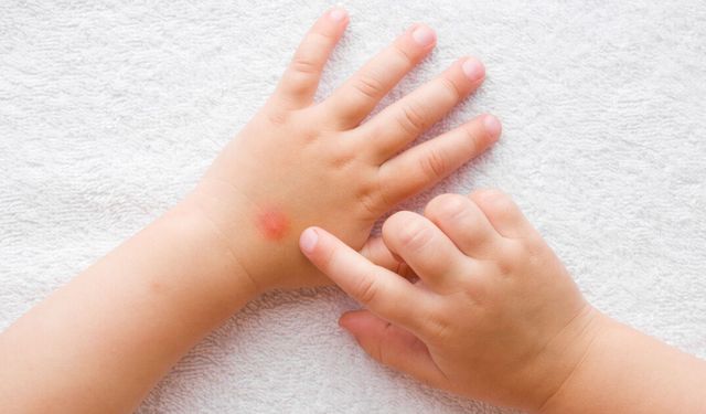 Sivrisinek Kabusuna Mucize Çözüm: Kaşıntıyı Bıçak Gibi Kesiyor