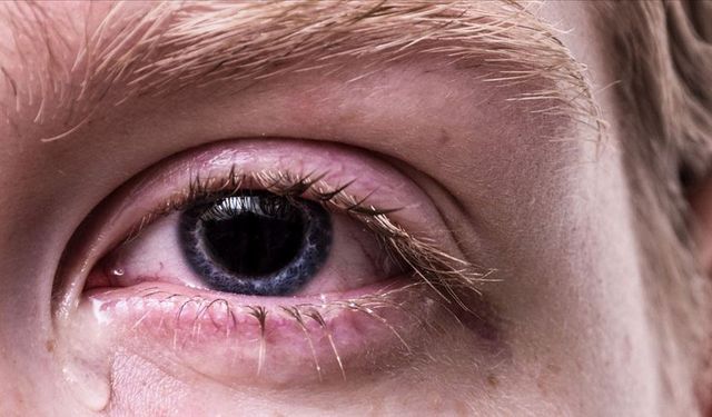 Gözlerde Batma ve Sulanma Ciddi Hastalık Habercisi
