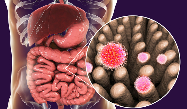 Dizanteri Nedir? Sebebi Nedir?