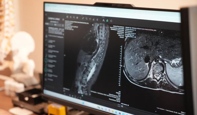 Skolyoz Erken Tanıyla Kontrol Altına Alınabilir