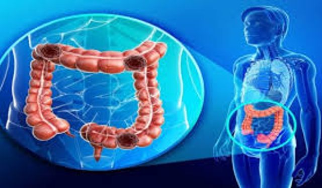 Kolon Kanserinde Erken Tanı Hayat Kurtarıyor