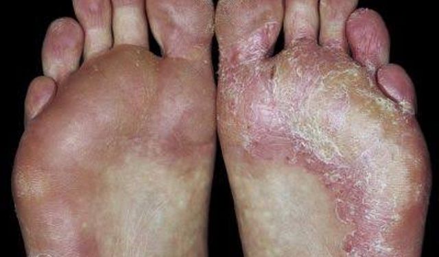 Ayak Mantarından Korunmak İçin 10 Etkili Önlem
