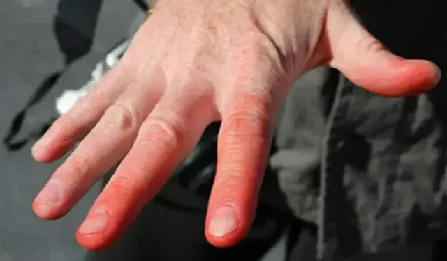 Soğuk Isırığı: Kışın Görünmeyen Tehlikesi