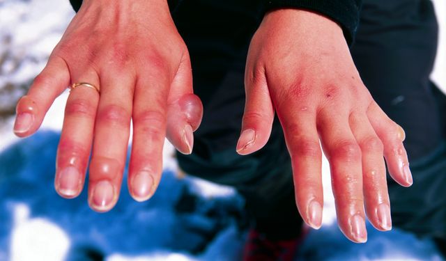 Soğuk ısırığına dikkat: Uzmanlardan önemli uyarılar