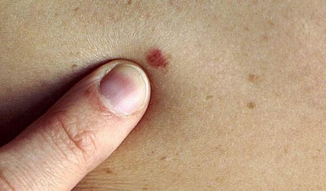 Güneşlenirken Dikkat: Cilt Kanseri Riskine Karşı Uyarı!