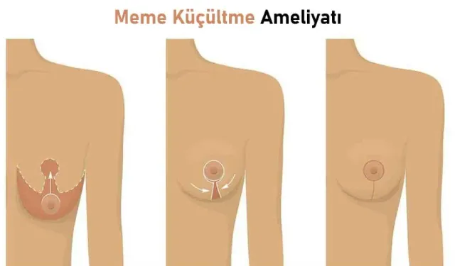 Meme küçültme estetikten fazlasını sağlıyor
