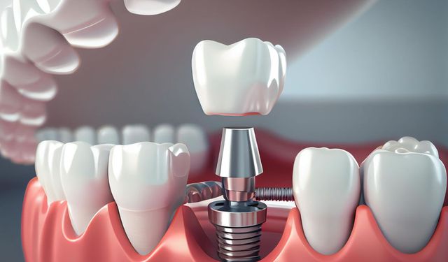 Çene kemiği erimesi olanlar implant yaptırabilir mi?