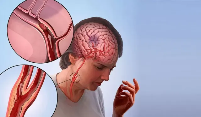 Yüzde kayma ve konuşma bozukluğu inme belirtisi olabilir